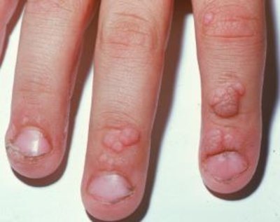 Imagem de dedos com verrugas Dicas para acabar com as verrugas