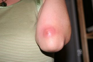 Boils - Treatments, Causes, Symptoms of Boils - WebMD