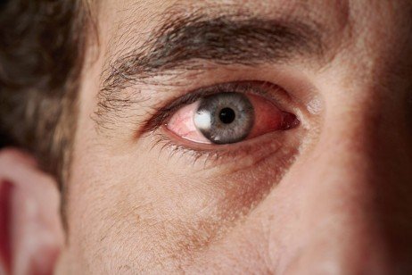 Compreenda seus sintomas para ajudar no diagnóstico! Cuidando dos olhos irritados
