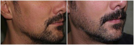 Você pode escolher onde quer preencher a barba! Implante capilar na barba