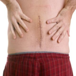 Como é a recuperação de cirurgias de hérnia? Recuperação de cirurgia de hérnia