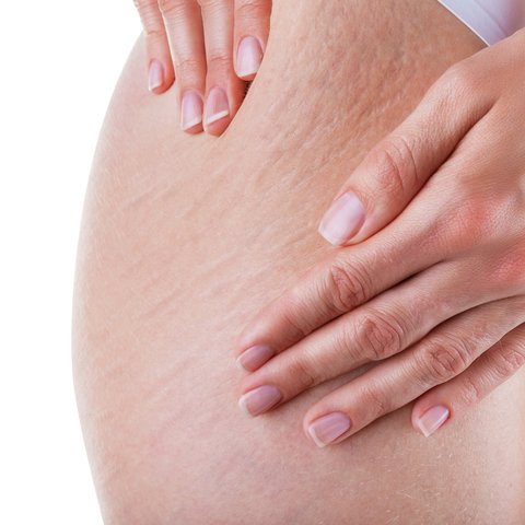 Tratando contra estrias e celulite: alimentação correta! Reduzindo as calorias da alimentação para tratar estrias e celulite