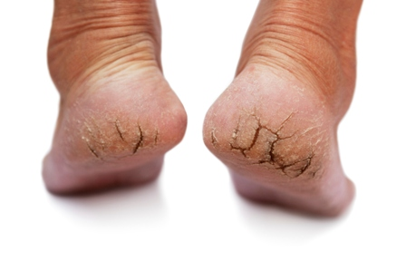 Trate seus pés rachados da forma certa! Tratamento de pés rachados