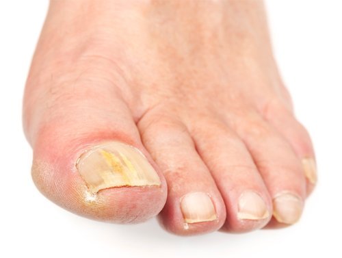 Sua unha está preta ou mais grossa? Veja como resolver! Cuidados com unhas com problemas