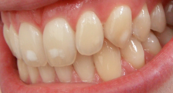 Nem toda mancha branca é ruim! Como cuidar das manchas brancas nos dentes