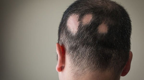 O que a alopecia areata pode causar? Alopecia areata