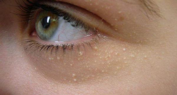 Como tratar o xantelasma? Xantelasma