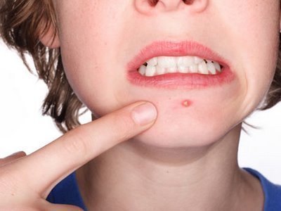 Receita natural contra espinhas