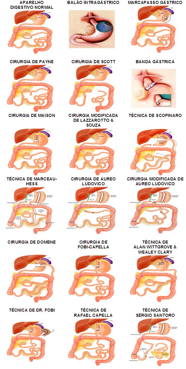 Tipos de cirurgia bariátrica