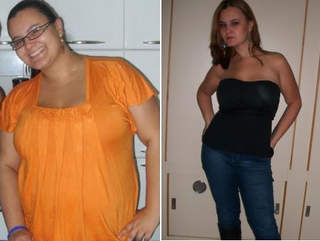 Antes e depois da cirurgia
