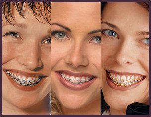 Aparelhos dentários e idade certa para eles