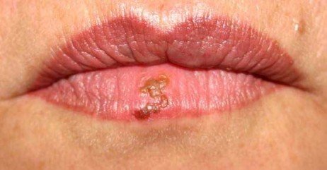 Longe da cura da herpes