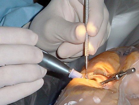 Riscos da cirurgia para cataratas