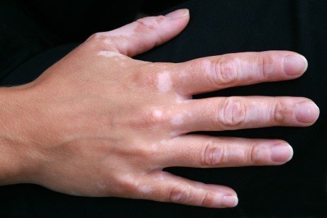 Corpo e áreas afetadas pela vitiligo