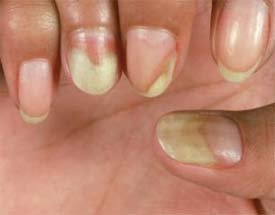 Complicações das unhas amareladas