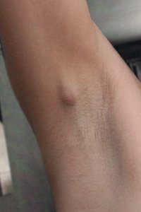 Finding Hard Lumps Under Skin - Symptomfind
