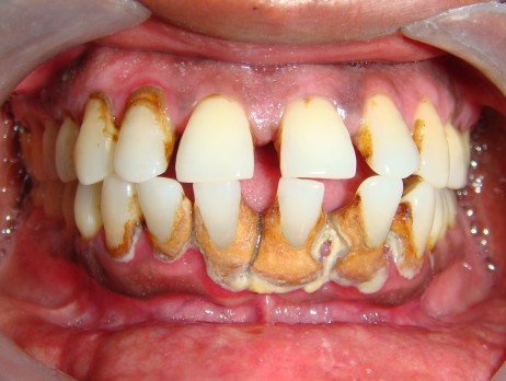 Efeitos do tártaro nos dentes