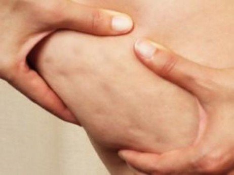 Evitando a celulite no seu corpo
