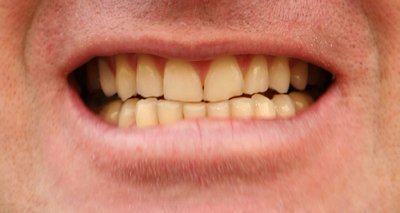 Prevenção e tratamento para dentes amarelados