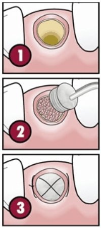 Preenchimento das cavidades dentárias