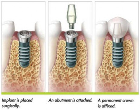 Passo a passo do implante dentário