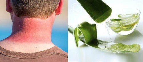Usando o aloe vera para queimaduras de sol