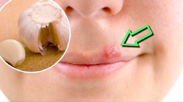 Tratamentos para a herpes labial