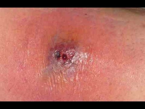 Identificando mordida de aranha