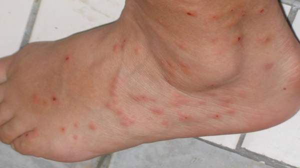 Identificando mordidas de pulgas