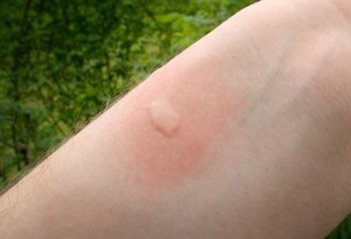 Efeitos de uma picada de mosquito