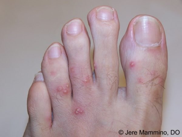 Mordida de formigas em pé de pessoa