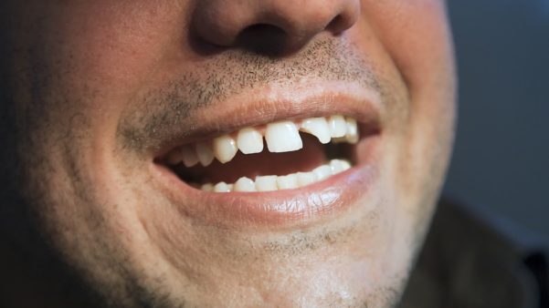 Dente quebrado o que fazer