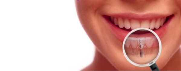 Vantagens dos implantes dentários
