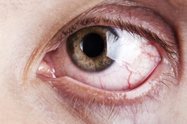 Cuidados com descolamento de retina