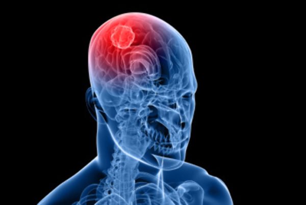 Qual a chance de cura de um tumor no cérebro?
