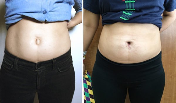 H rnia Umbilical Sintomas Causas E Tratamento Sa de Melhor h-rnia-umbilical-sintomas-causas-e-tratamento-sa-de-melhor
