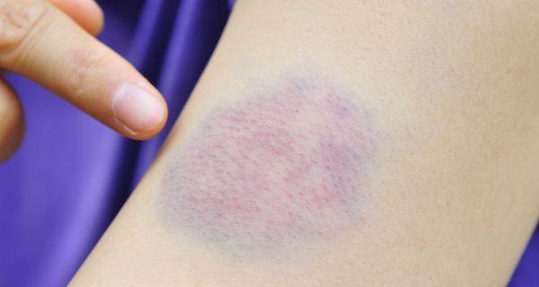 Roxo na pele
