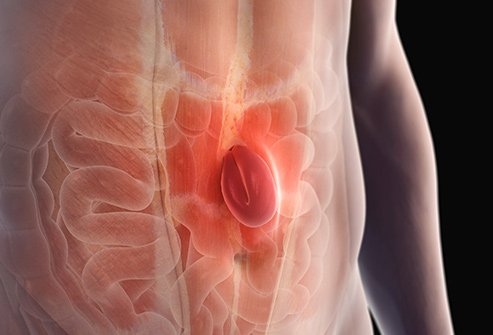 Hérnia umbilical