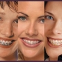 Tem idade certa para colocar aparelho ortodôntico (nos dentes)?