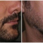 Implante de barba! Preços e antes e depois! [Com vídeo]