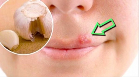 Remédio caseiro para herpes labial! Tratamento rápido!