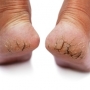 O que causa rachaduras nos pés? Remédio caseiro e tratamento!