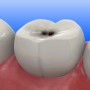 Cárie dentária: o que é? Sintomas e tratamentos!