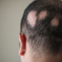 Alopecia areata: tratamentos, causas, sintomas