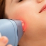 Tratamento a laser para acne, como funciona? Preço?