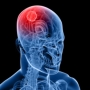 7 sinais de um tumor cerebral
