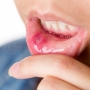 Câncer bucal, como prevenir? Sintomas e tratamento!