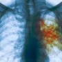 Tuberculose: sintomas e tratamento!